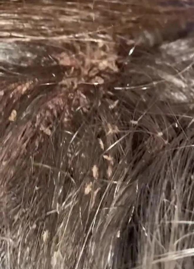 Rùng mình clip bắt chấy nghìn con 46 triệu lượt xem, nhìn mà SỐC-1