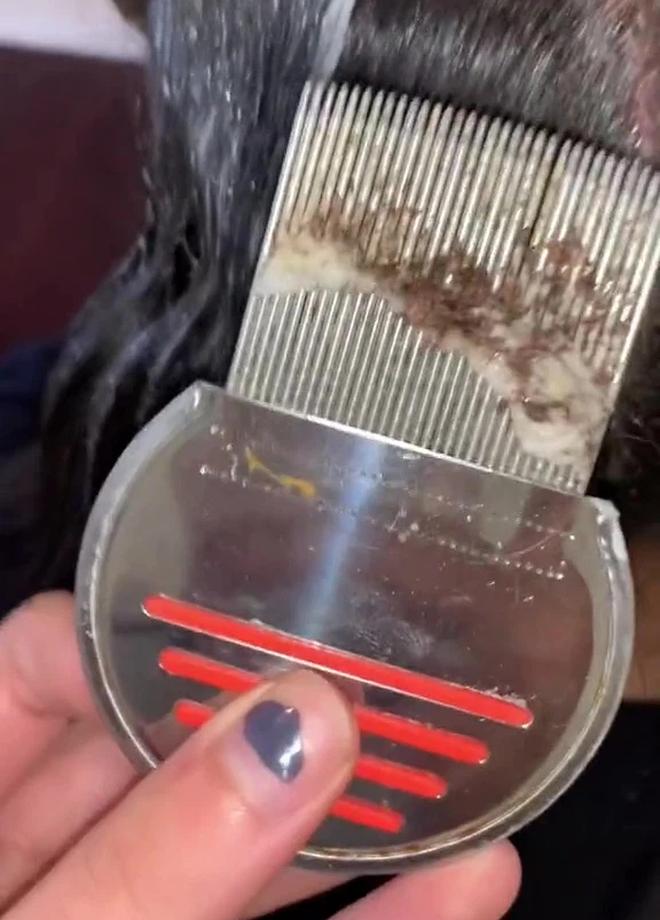 Rùng mình clip bắt chấy nghìn con 46 triệu lượt xem, nhìn mà SỐC-3