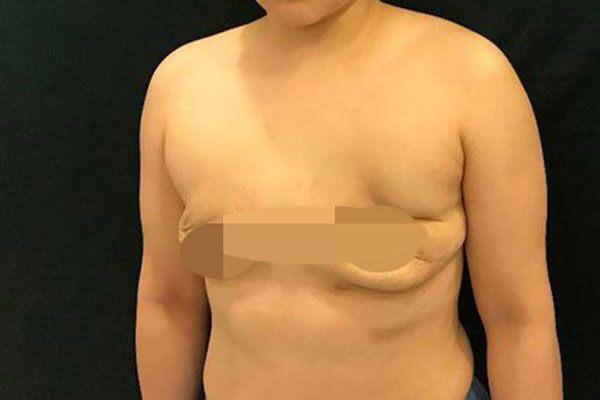 Pha trùng tu vòng 1 để lại sẹo đi vào lòng đất.