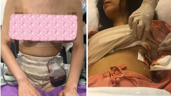 Sau đó cô phải đi phẫu thuật rút toàn bộ silicon ra.