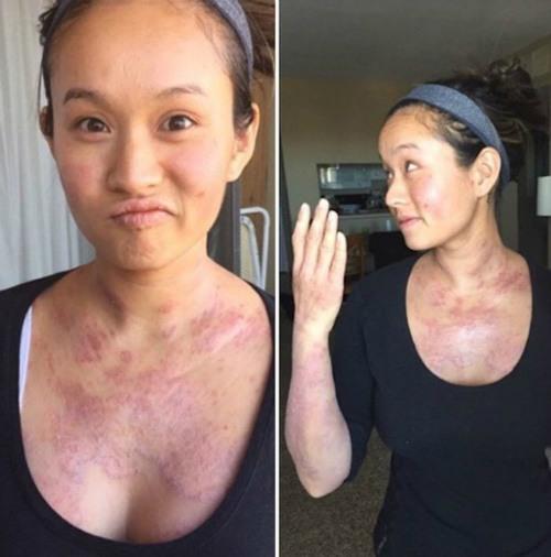 Cô gái bị nổi mẩn, bong tróc khắp người sau khi nâng ngực sau 4 tháng.