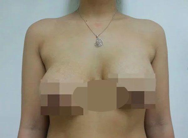 Biến chứng nâng ngực bị lệch, chảy xệ, bên to bên nhỏ.