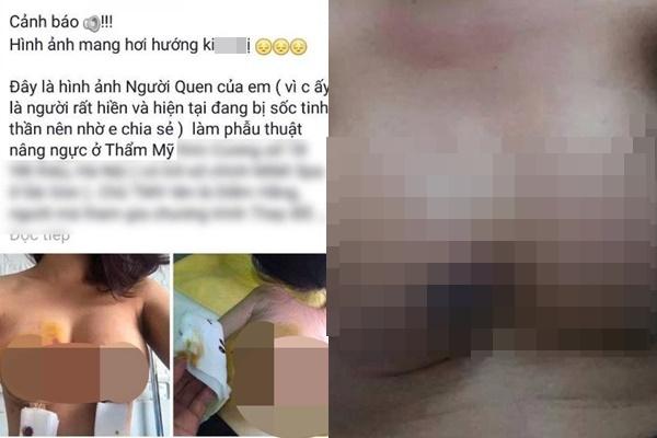 Ham hố tiêm filler, gái xinh khóc thét vì môi cuốn lô hệt gái ngành-6