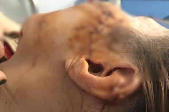 Truy nã gã chồng chém vợ thương tích 42% rồi bỏ trốn