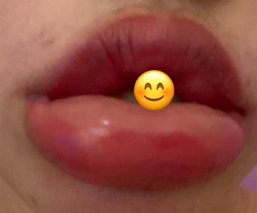 Ham hố tiêm filler, gái xinh khóc thét vì môi cuốn lô hệt gái ngành-4