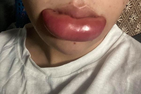 Lầm tưởng về tiêm filler-4