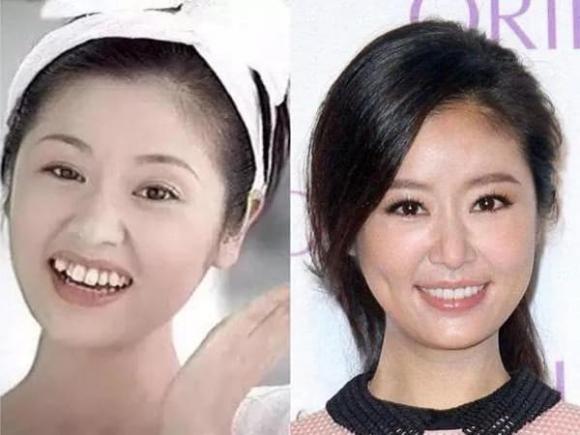 Lâm Tâm Như và loạt sao Cbiz lột xác sau khi phẫu thuật răng-2