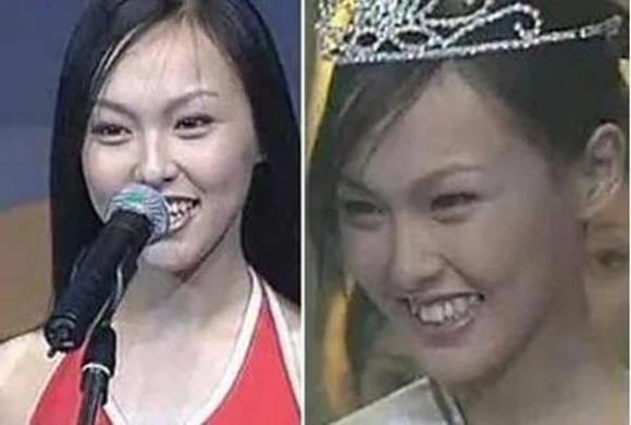 Lâm Tâm Như và loạt sao Cbiz lột xác sau khi phẫu thuật răng-3