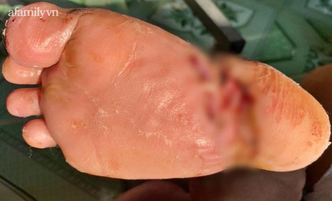 Bé trai 5 tuổi ở TP HCM bị xe nâng hàng cắt đứt bàn chân phải-3