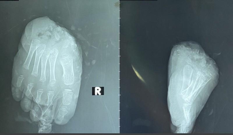 Bé trai 5 tuổi ở TP HCM bị xe nâng hàng cắt đứt bàn chân phải-2
