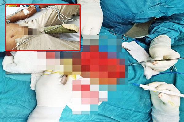 Thanh niên bị thanh sắt xuyên từ đùi ra sau, treo trên thành cầu-3