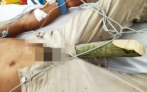 Kinh hãi: Thanh niên bị cọc lá dừa đâm xuyên bộ phận sinh dục-1