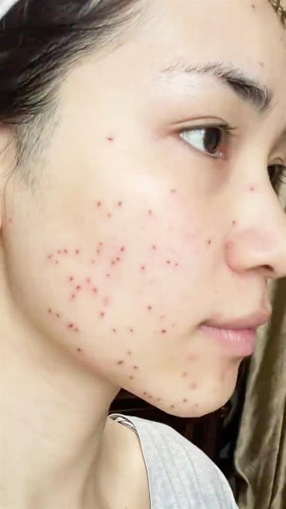 Hòa Minzy truyền kinh nghiệm xử lý mụn thịt chi chít trên mặt-5