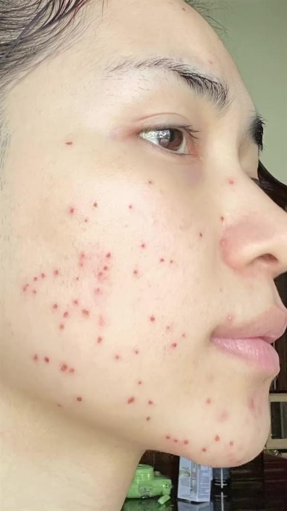 Hòa Minzy truyền kinh nghiệm xử lý mụn thịt chi chít trên mặt-6