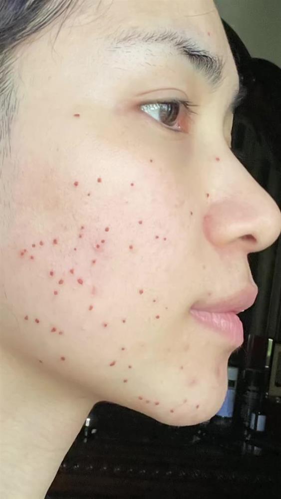 Hòa Minzy truyền kinh nghiệm xử lý mụn thịt chi chít trên mặt-7