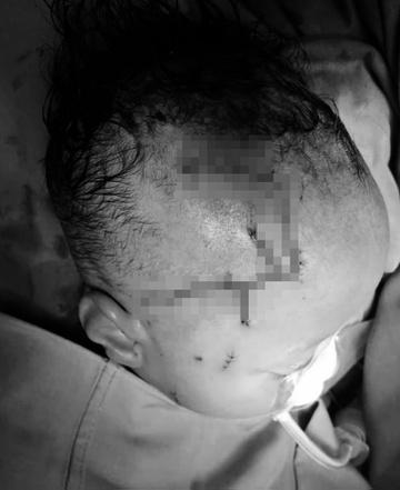 Bé 2 tuổi bị chó cắn tổn thương nặng vùng đầu-1