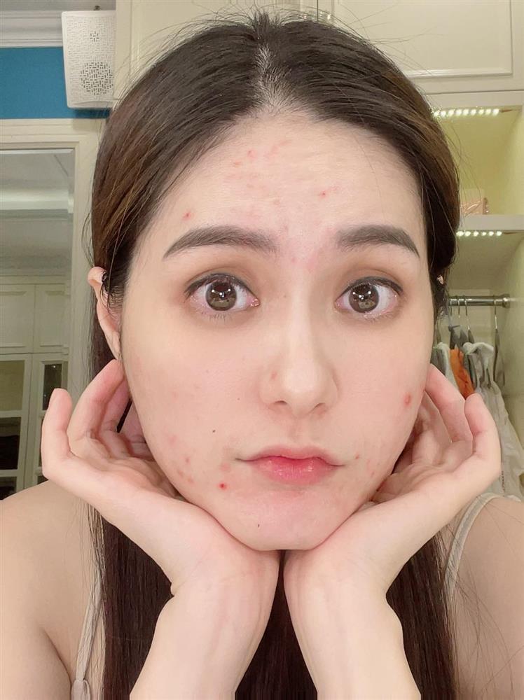 Đoàn Di Băng gây choáng với gương mặt chi chít mụn đỏ-1