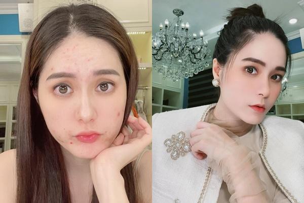 Đoàn Di Băng gây choáng với gương mặt chi chít mụn đỏ-3