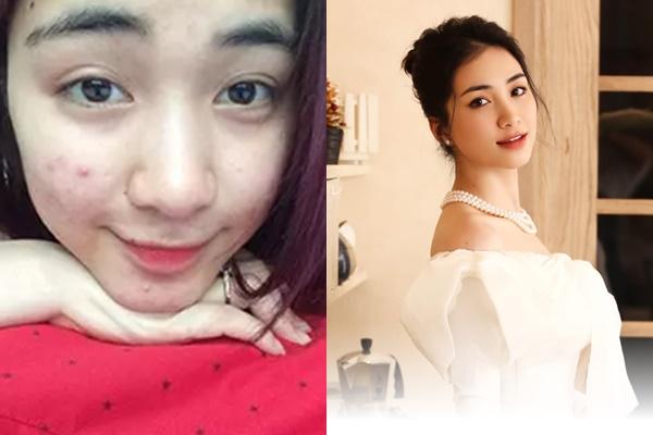 Đoàn Di Băng gây choáng với gương mặt chi chít mụn đỏ-5