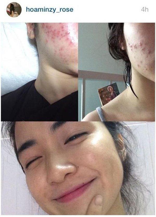 Đoàn Di Băng gây choáng với gương mặt chi chít mụn đỏ-4