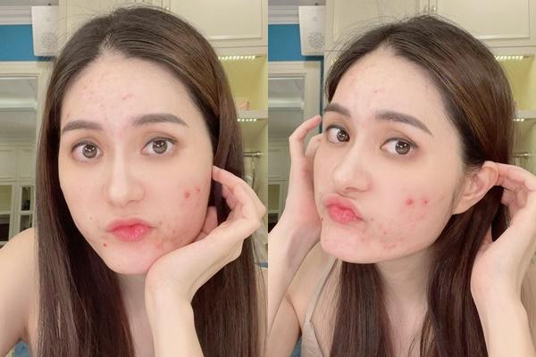 Đoàn Di Băng gây choáng với gương mặt chi chít mụn đỏ-2