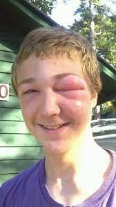 Cạn lời với những khuôn mặt đáng thương bị ong đốt túi bụi-1