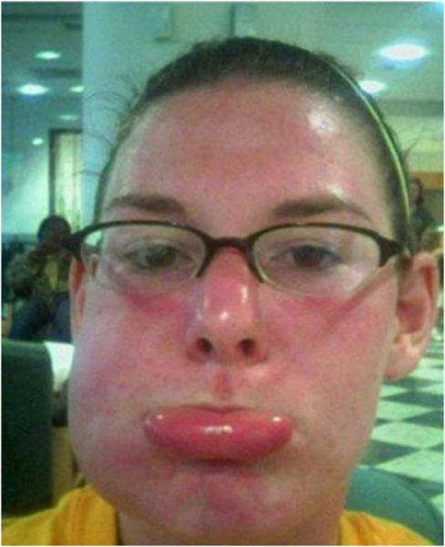 Cạn lời với những khuôn mặt đáng thương bị ong đốt túi bụi-4