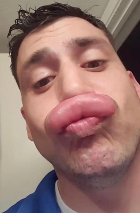 Cạn lời với những khuôn mặt đáng thương bị ong đốt túi bụi-6