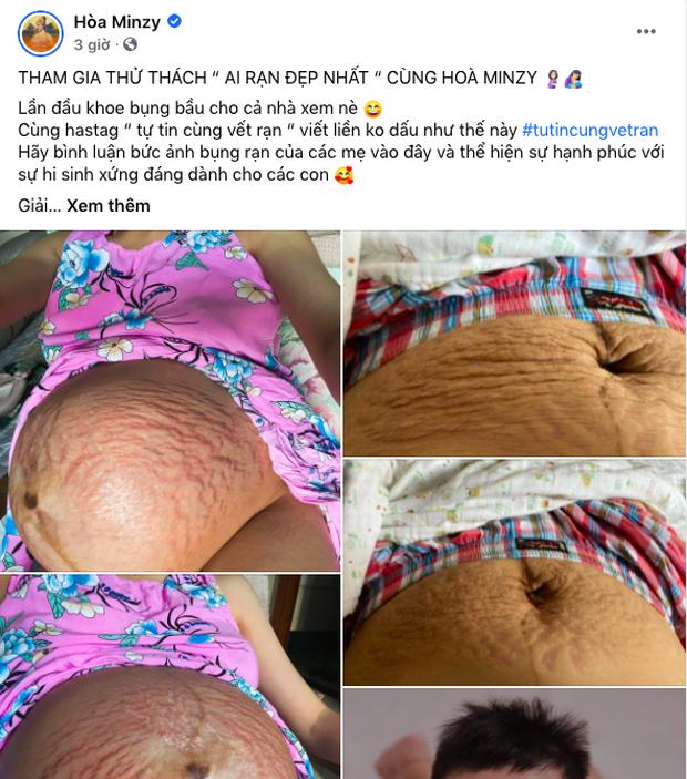 Không chỉ rạn chi chít bụng, Hòa Minzy còn rụng hết tóc-5