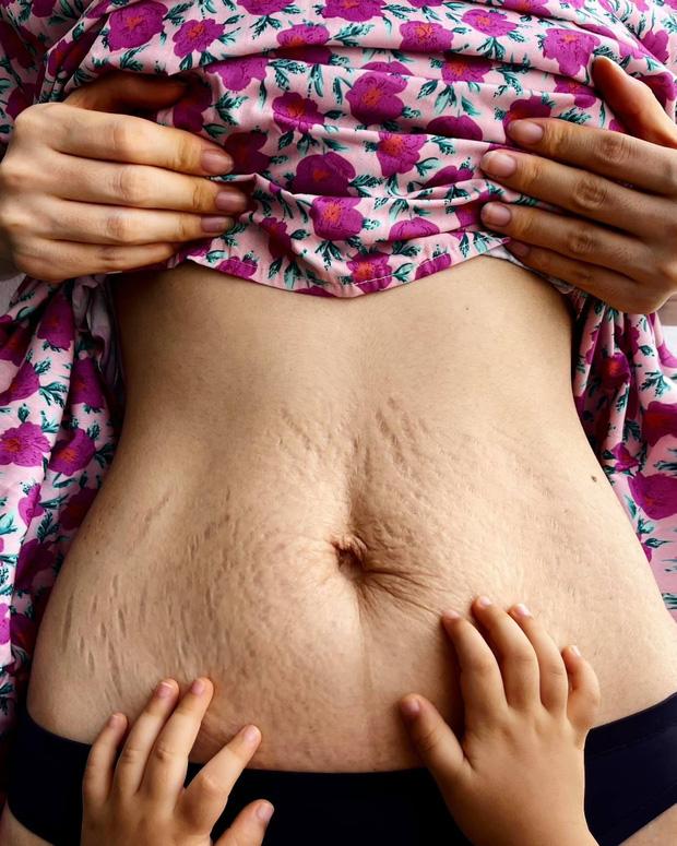 Không chỉ rạn chi chít bụng, Hòa Minzy còn rụng hết tóc-4