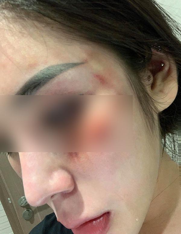 Hotgirl nổi tiếng tố bị bạn trai đánh đập dã man, thương tật 28%-1