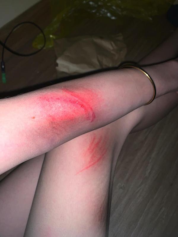 Hotgirl nổi tiếng tố bị bạn trai đánh đập dã man, thương tật 28%-2