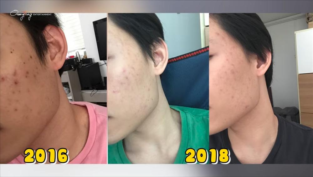 Quang Trung làn da chi chít mụn vì sai lầm nhiều người mắc-5