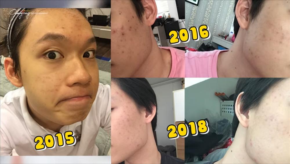 Quang Trung làn da chi chít mụn vì sai lầm nhiều người mắc-1