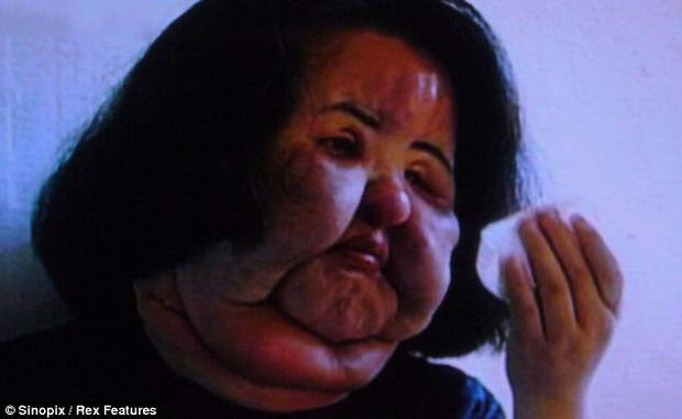 Thảm hoạ thẩm mỹ Han Mi Ok: Tự tiêm dầu ăn và cái chết chấn động-14