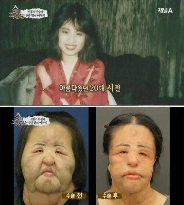 Thảm hoạ thẩm mỹ Han Mi Ok: Tự tiêm dầu ăn và cái chết chấn động-6