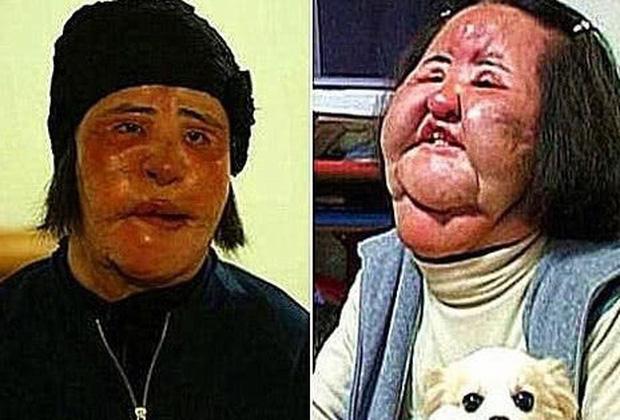 Thảm hoạ thẩm mỹ Han Mi Ok: Tự tiêm dầu ăn và cái chết chấn động-8