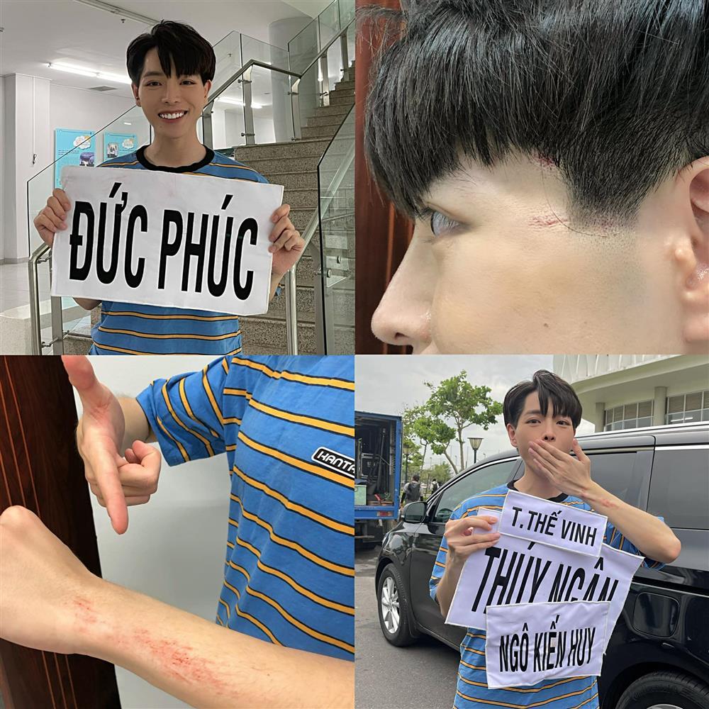 Đức Phúc trầy từ mặt tới thân khi tham gia Running Man-1