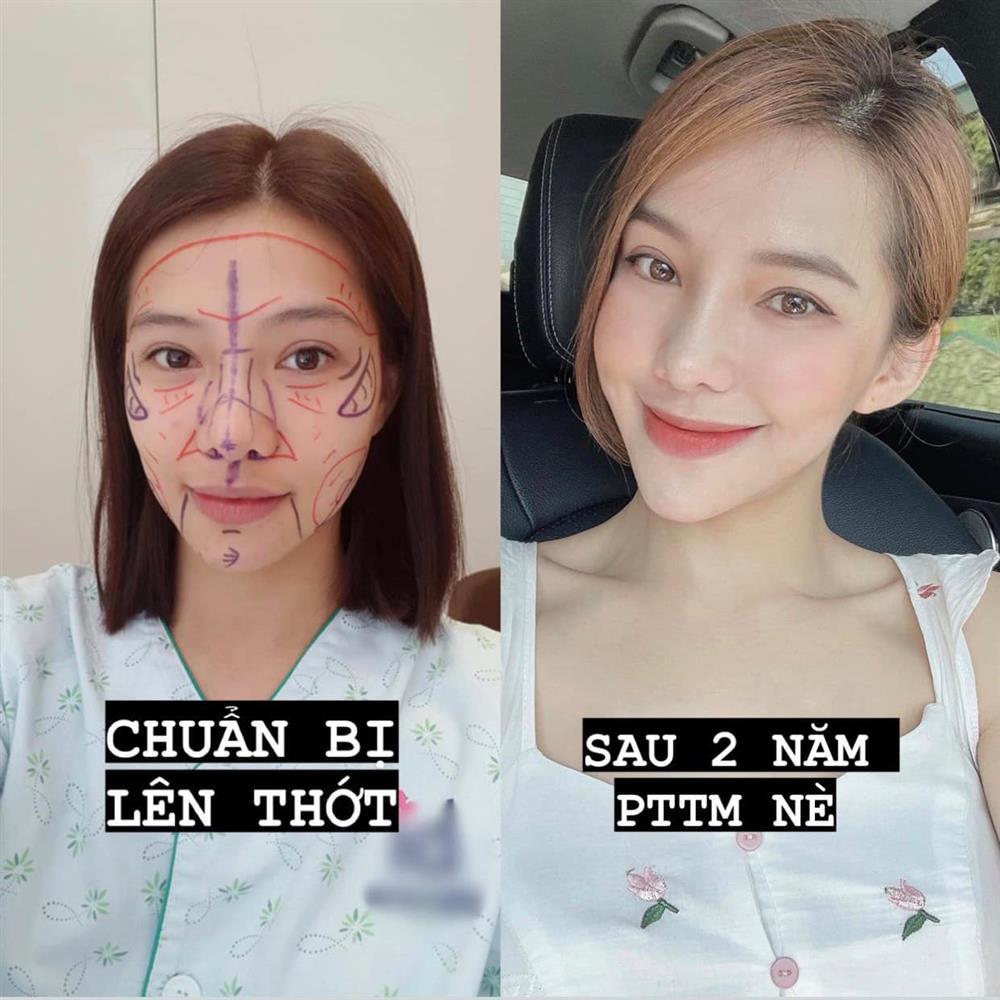 Giật mình gương mặt Lưu Đê Ly lúc phẫu thuật thẩm mỹ-3