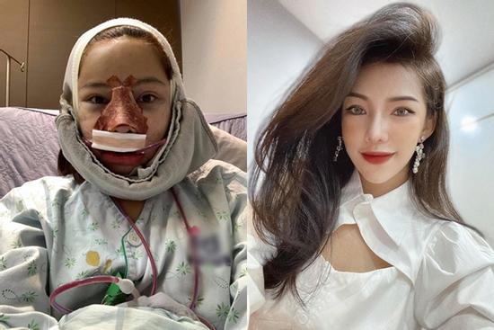 Giật mình gương mặt Lưu Đê Ly lúc phẫu thuật thẩm mỹ