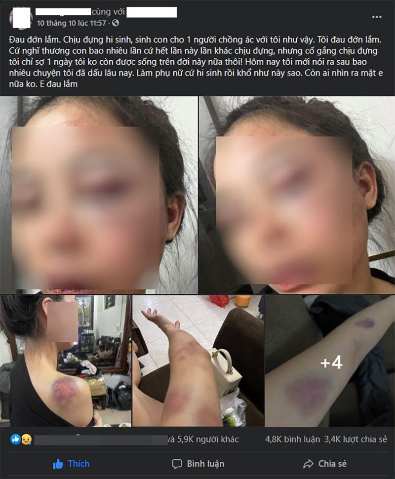 Vợ 9X bị chồng bạo hành, dùng gậy sắt đánh biến dạng mặt-1
