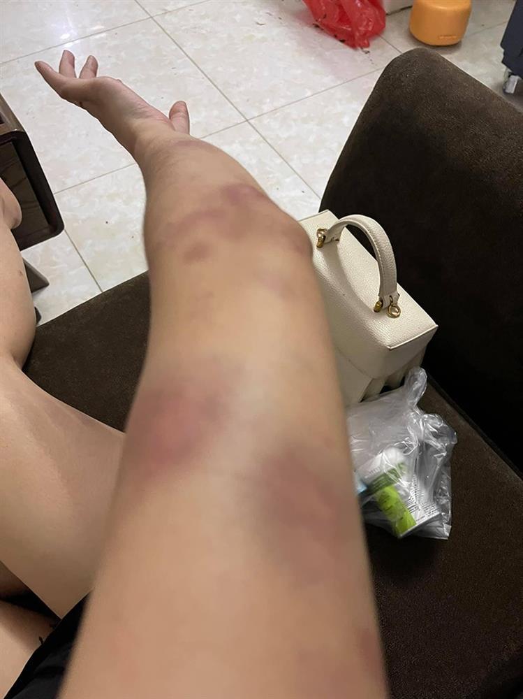 Vợ 9X bị chồng bạo hành, dùng gậy sắt đánh biến dạng mặt-4