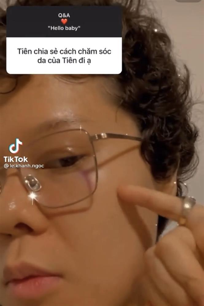 Ngã ngửa cách trị mụn ẩn hiệu quả không tưởng của Tiên Tiên-2