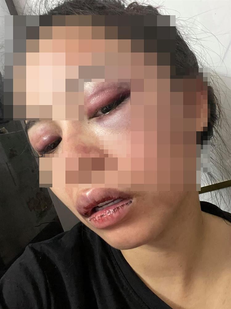 Vụ vợ bị chồng bạo hành xuyên đêm: Em đau đến tuyệt vọng-1