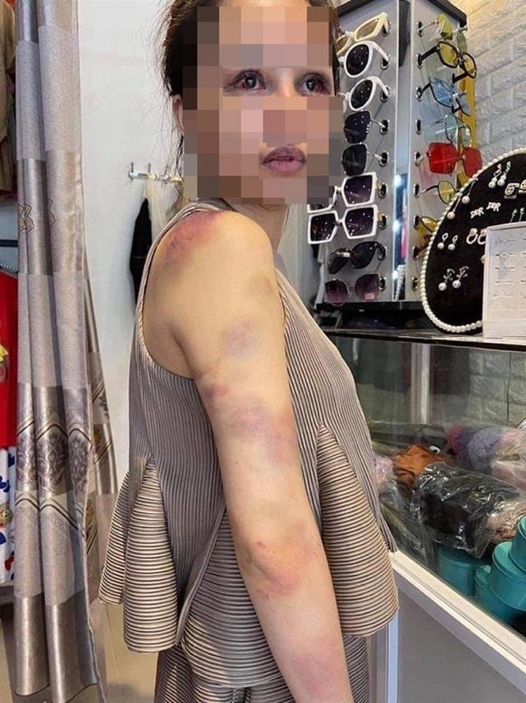Vụ vợ bị chồng bạo hành xuyên đêm: Em đau đến tuyệt vọng-2