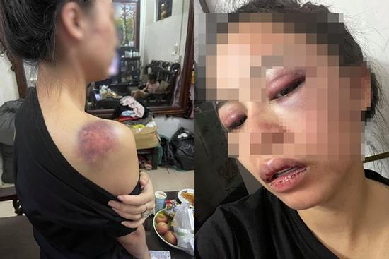 Vụ vợ bị chồng bạo hành xuyên đêm: 'Em đau đến tuyệt vọng'