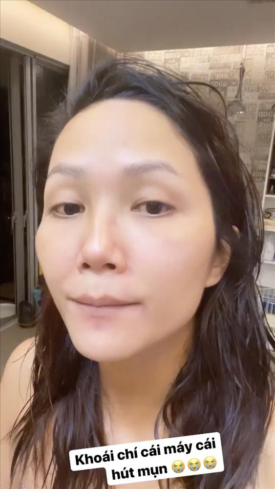 HHen Niê để lộ gương mặt nhiều vết thâm tím như bị bạo hành-1
