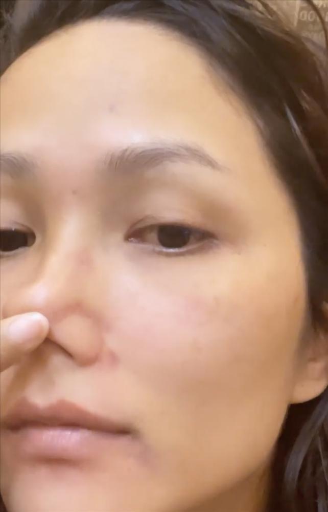 HHen Niê để lộ gương mặt nhiều vết thâm tím như bị bạo hành-4