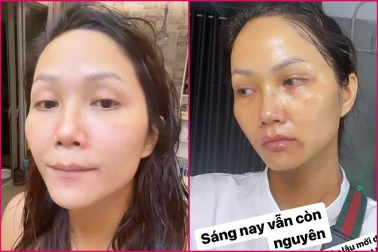 H'Hen Niê để lộ gương mặt nhiều vết thâm tím như bị bạo hành