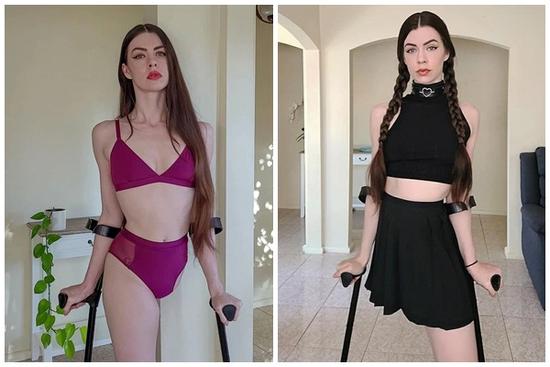Cô gái cụt chân trở thành mẫu nổi tiếng và câu chuyện truyền cảm hứng